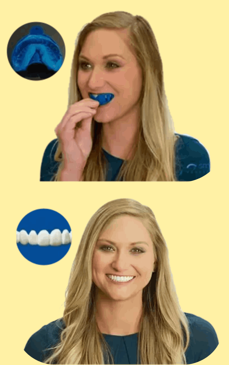 Shiny Smile Veneers 18