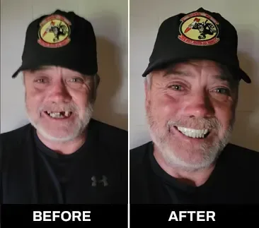 Shiny Smile Veneers 4