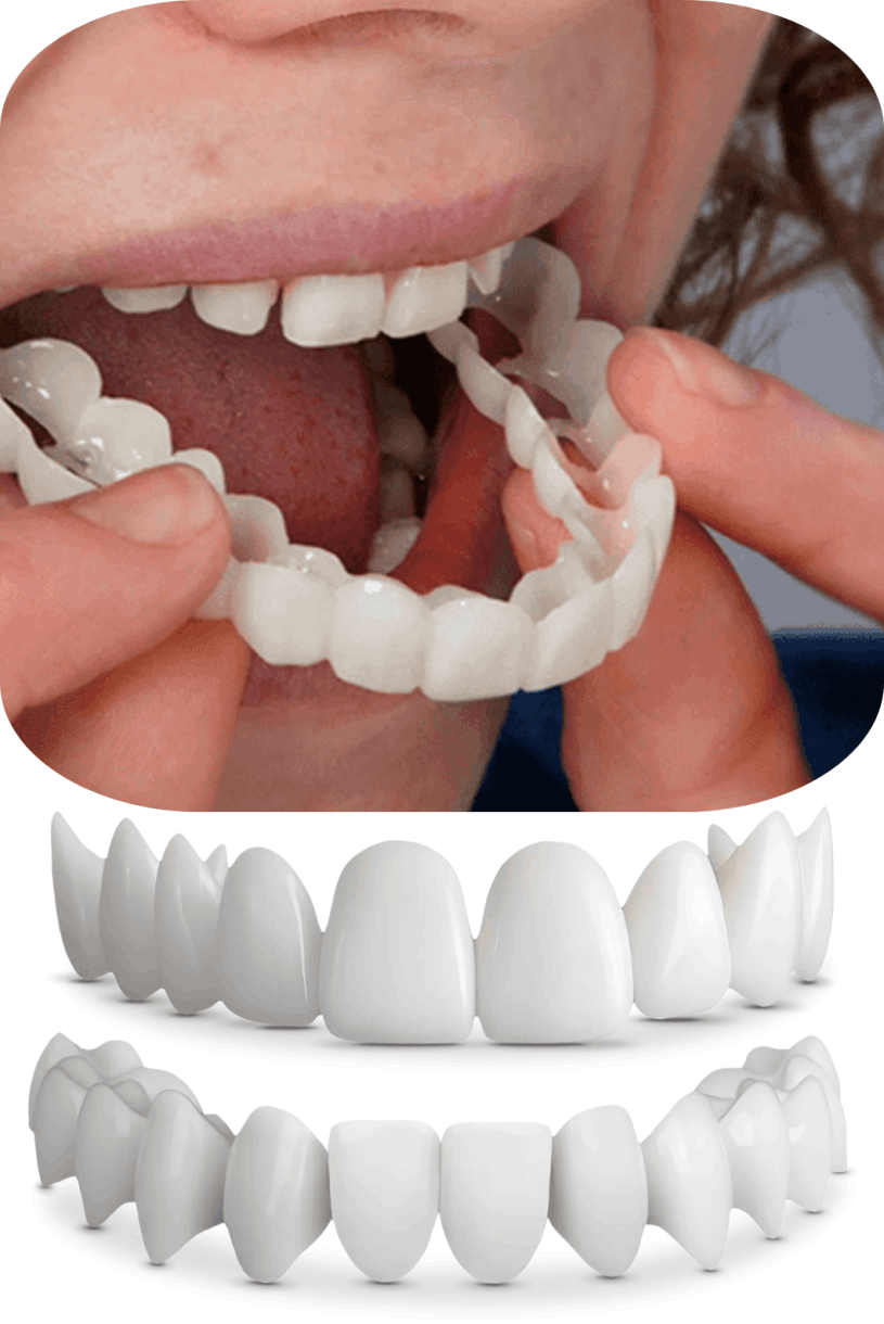 Shiny Smile Veneers 7